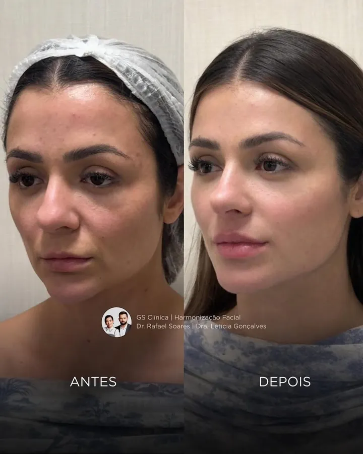Antes e depois: rosto com aspecto caído