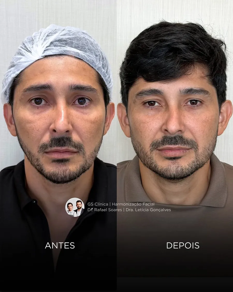 Antes e depois de harmonização masculina com mais definição