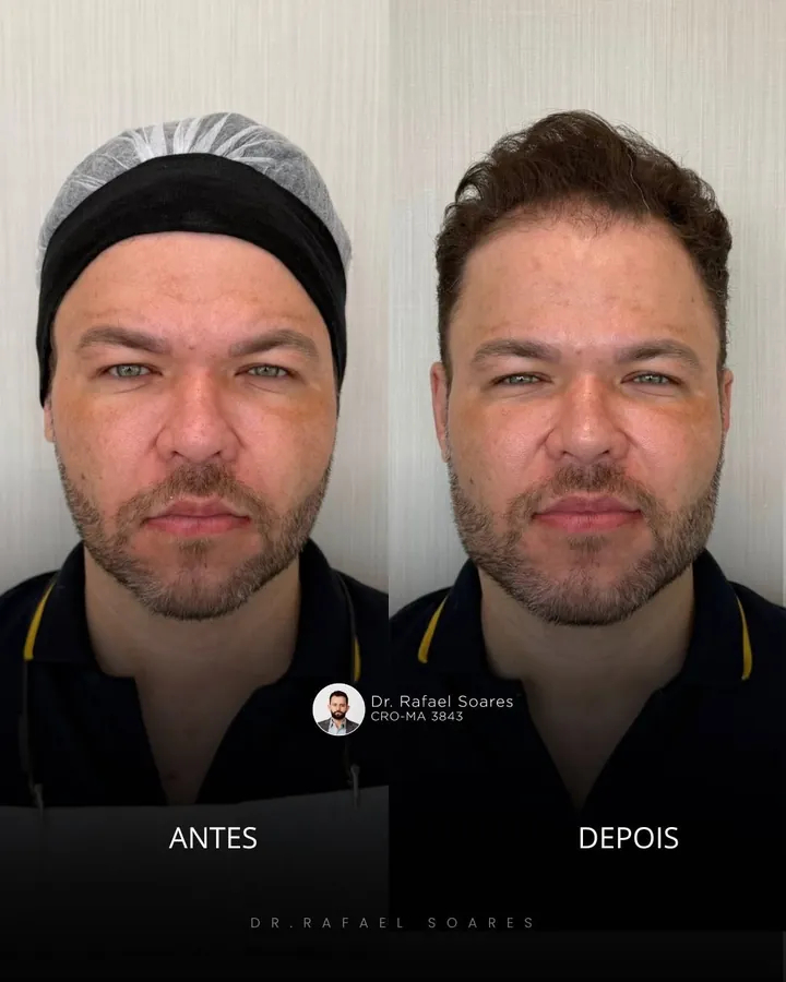 Antes e depois: contorno mandibular