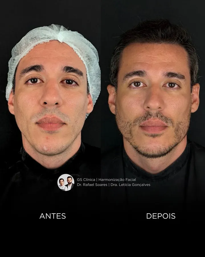 Antes e depois: harmonização masculina